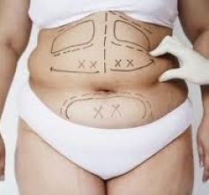 ABDOMINOPLASTIA